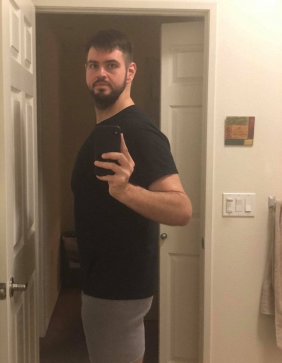 美小伙為愛減重270斤做手術(shù)去除多余松弛皮膚